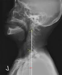 The plumb meaning is plumbing. Distance Between The C2 And C7 Plumb Lines Plumb Line Was Defined As Download Scientific Diagram