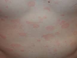 Tinea versicolor is a common, benign, superficial cutaneous fungal infection usually characterized by hypopigmented or hyperpigmented macules and patches on the chest and the back. Pityriasis Versicolor Dermnet Nz