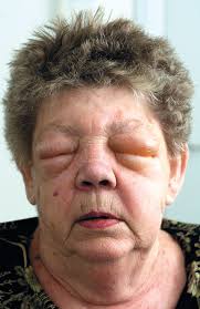 Image result for Angioedema