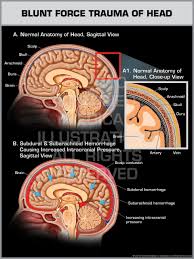 Trauma refers to a type of physical trauma caused to a body part, either by impact, injury or physical attack; Blunt Force Trauma To The Head Skull Page 1 Line 17qq Com