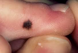Only 2 to 8% are amelanotic melanomas, which. Skin Cancers Of The Feet Achilles Podiatry
