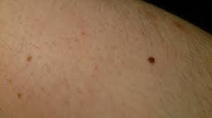 Denne er mye mørkere enn andre føflekker jeg har på kroppen. Foflekk Pa Leggen Som Skiller Seg Ut Grunnlag Nok For Et Legebesok Bilder Helse Diskusjon No