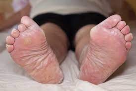 Maybe you would like to learn more about one of these? 10 Common Causes Of Dry Skin On The Foot Toes