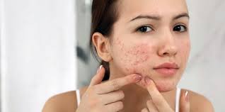 Penasaran seperti apa cara menghilangkan merkuri di wajah secara alami? Kulit Beruntusan Setelah Coba Skincare Purging Atau Iritasi Ketahui Bedanya Merdeka Com