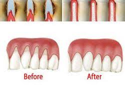 Grow Back Your Receding Gums In No Time With The Help Of These Natural Remedies Receding Gums Natural Health Care Natural Remedies