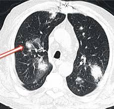 Infections caused by these microorganisms, are usually acquired through the respiratory route since the spores of fungi are found in the environment. Infecciones En El Paciente Inmunocomprometido Ii Paciente Trasplantado Sciencedirect