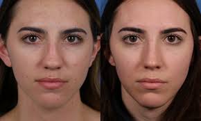 The hair as this can cause the hair on the sides to stick out and . Rhinoplasty Bulbous Rounded Nasal Tip Dr Hilinski