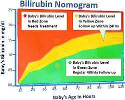 Jaundice in newborns is common. Jaundice In Newborns Bilirubin Levels Bilirubin Newborns Baby Jaundice