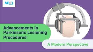 Image result for Pallidotomy