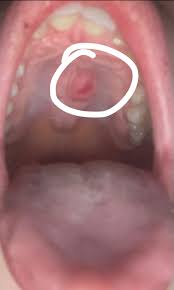 Image result for Canker sores symptoms roof of the mouth