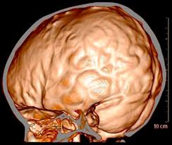 Head growth curve <ul><li>5/48 (10.41%) children had deceleration in head growth in the follow up period, of which only one child was symptomatic for raised icp and that child had bca as. Copper Beaten Skull The Journal Of Pediatrics