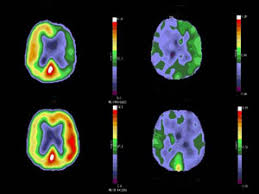 A pet scan may not be possible if you are obese and unable to fit into the scanning chamber (gantry). Pet Scan Positive Emission Tomograpy Information Myvmc