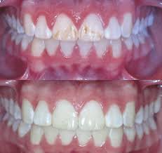 Brush your teeth with a whitening toothpaste once or twice a week while using products to promote white teeth, and use standard toothpaste for daily use. Brown Stains On Teeth After Braces Removed Teethwalls