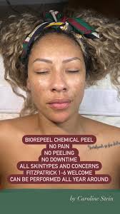 The best Chemical Peel in the industry 💣 * No Pain * No Peeling * No  Downtime * Fitzpatrick 1-6 are welcome * All skin types and concerns * Best  to get it done