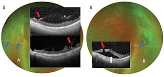 If your retina has detached, you'll need surgery to repair it, preferably within days of a diagnosis. The Usual Retina Suspects Modern Optometry