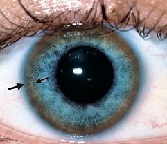 Optometry Reviews | Kayser-Fleischer ring. I first heard of this eye finding on an episode of House way back during undergrad, back before I even thought of... | Instagram