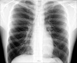 Sep 11, 2019 · intestinal gas, abdominal bloating and distension bothers most people occasionally. Thorax Wikipedia
