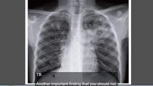 We did not find results for: Tuberculosis Active Tb Chest X Ray Youtube