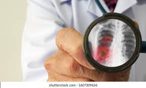 Pneumonia High Res Stock Images Shutterstock