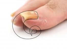 horn nails onychogryphosis symptoms