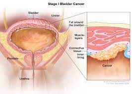 Over time, these cells can become cancerous, causing the condition to worsen. Bladder Cancer Treatment Bladder Cancer Pictures Signs Symptoms To Better Understand Diagnosis Cleveland Oh University Hospitals
