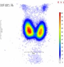Bei der szintigraphie der schilddrüse handelt es sich um eine radiologische (präziser gesagt: Diagnostik Der Schilddruse Ev Klinikum Bethel Ihr Krankenhaus In Bielefeld