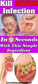 There S Nothing More Annoying Than A Runny Nose And Itchy Throat It S Even Worse When Your Sinuses Swe Sinus Remedies Sinus Infection Remedies Sinus Infection