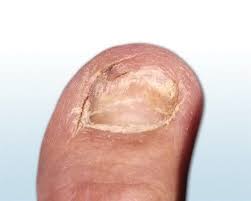 Nagelpilz Definition Erreger Symptome Bilder Ciclopoli