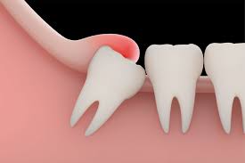 Timeline Of Recovery After Wisdom Teeth Extraction