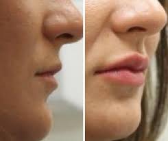 Don't drink alcohol for a few days before or after (alcohol can thin the blood and make bruising worse) after an injection, you'll feel normal after a day or two. Lip Fillers Before And After Uk Lip Fillers Cost Lip Fillers Free Consultation