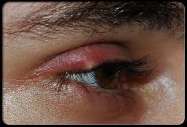 Common Eye Problems and Infections