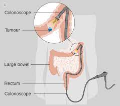 These changes are the result of the interaction between a person's genetic factors and three categories of. Bowel Cancer Symptoms And Treatment