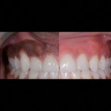 Weak Tooth Extraction Healing Pictures Toothlesssmile Wisdomteethpainrelief Dental Bridge Cost Sensitive Teeth Remedy Sensitive Teeth