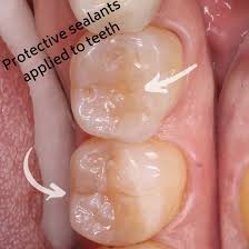 Dental sealants can prevent cavities in children and adults for years, but are they worth the cost and as soon as your child is getting new teeth in with grooves called 'pits and fissures' like molars and. Fight Cavities With Sealants Smile Gallery Humble Dentist