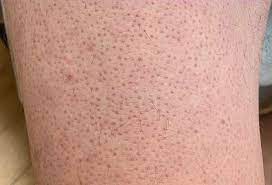 I hav this ingrown hair problem on my legs,arms and under arms after few days of waxin and due to that i got marks on my legs and arms.can u plz suggest me some solution to it? Keratosis Pilaris Wikipedia