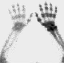 Complex Regional Pain Syndrome Thoracic Key