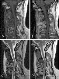 Maybe you would like to learn more about one of these? Cervical Spine Spondylodiscitis Mimicking Teardrop Fracture Sciencedirect