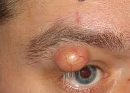 Image result for milium cyst on eyelid