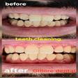 Teeth cleaning and polishing product image