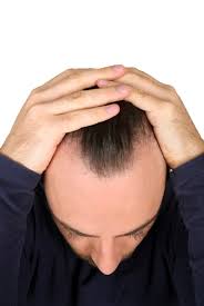 A report from the multidisciplinary androgen leavitt m., charles g., heyman e., michaels d. Hair Loss Minoxidil Topical Treatment Male Pattern Baldness