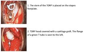 Image result for Ossicular Chain Disruption