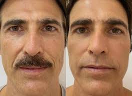 Ao participar de uma live no instagram promovida pelo médico . Reynaldo Gianecchini Does Facial Rejuvenation I M Impressed Ruetir