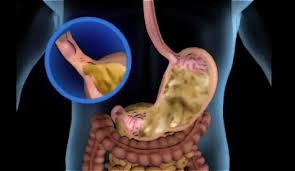 For more information and source, see on this link : Simptom Gastrik Dan Cara Untuk Mengatasinya Eratuku