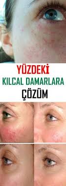 Yuzdeki Kilcal Damar Problemi Icin Dogal Maske Tarifi Vipbakim Saglik Bakim Vucut Bakimi Yuzler