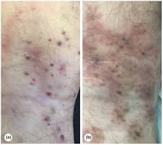 Cutaneous and subcutaneous Kaposis sarcoma lesions treated with  electrochemotherapy - Lalanda - 2023 - International Journal of Dermatology  - Wiley Online Library
