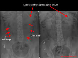 Image result for Nephrolithiasis Imaging