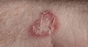 Hand sanitizer doesnt no, it actually cleans you hand and weakens all the germs on you hands. Dos And Don Ts To Treat Fungal Skin Infections Thehealthsite Com