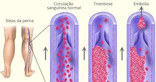 A trombose venosa pode ocorrer em todo o corpo, mas existe uma clara preferência pelas pernas. Trombose Sou Enfermagem