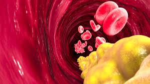 Deshalb entscheidet in den meisten fällen nicht alleine der cholesterinwert darüber, ob eine behandlung mit medikamenten nötig ist. Nilemdo Nustendi Neue Therapien Bei Hypercholesterinamie Apotheke Adhoc