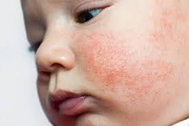 What to use for baby eczema. Baby Toddler Eczema Symptoms Treatment Relief Cerave